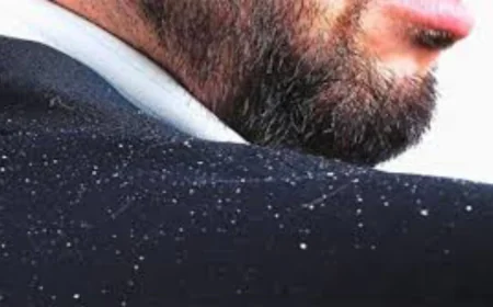 খুশকি দূর করার ঘরোয়া পদ্ধতি | প্রাকৃতিকভাবে খুশকি থেকে মুক্তির উপায়