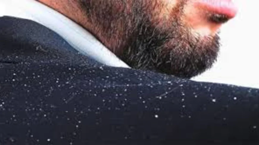 খুশকি দূর করার ঘরোয়া পদ্ধতি | প্রাকৃতিকভাবে খুশকি থেকে মুক্তির উপায়