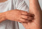 গরমে ঘামাচি দূর করবেন যেসব সহজ ঘরোয়া উপায়ে